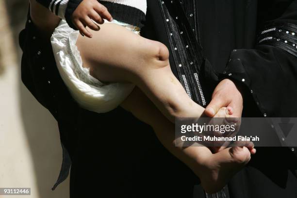 The feet of a child who suffers from a birth defect on November 12, 2009 in the city of Falluja west of Baghdad, Iraq. Birth defects have soared in...