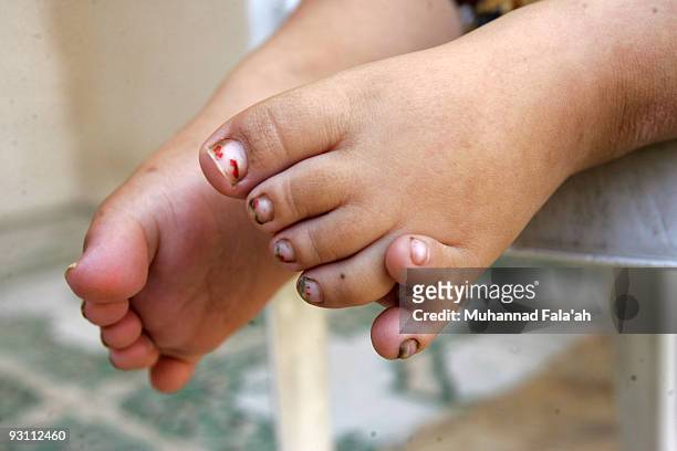 The feet of Zahra Muhammad, age 4 years old, who suffers from a birth defect are seen on November 12, 2009 in the city of Falluja west of Baghdad,...