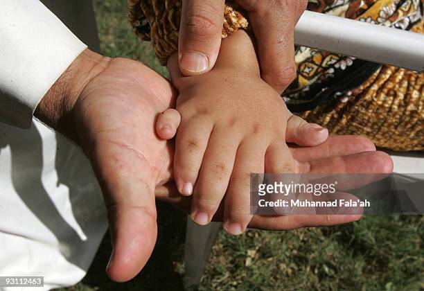 The father of Zahra Muhammad, age 4 years old, who suffers from a birth defect, shows her six fingered hand on November 12, 2009 in the city of...
