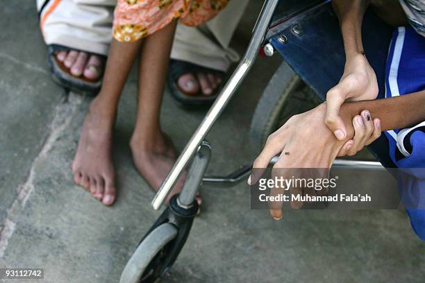 The hand of Anas Hamed , and the feet of his sister Inas who suffer from birth defects are pictured on November 12, 2009 in the city of Falluja west...