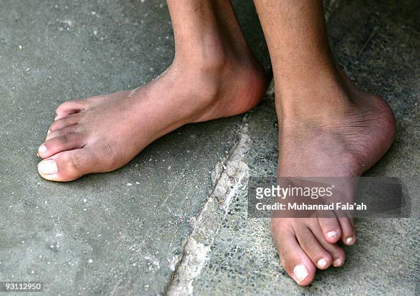 The feet of Inas Hamed, who suffers from a birth defect are pictured on November 12, 2009 in the city of Falluja west of Baghdad, Iraq. Birth defects...