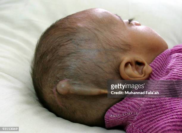 An Iraqi child suffering from a birth defect is pictured on November 12, 2009 at Falluja General Hospital in the city of Falluja west of Baghdad,...