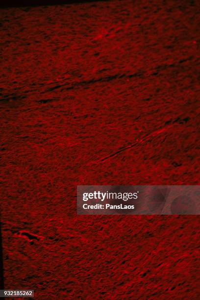 red fluorescence micrograph of ill human fibroma tumour - fibroma stock pictures, royalty-free photos & images