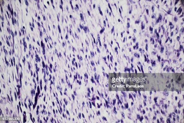 micrograph of cancer cell in human fibroma tumour - histerectomia fotografías e imágenes de stock