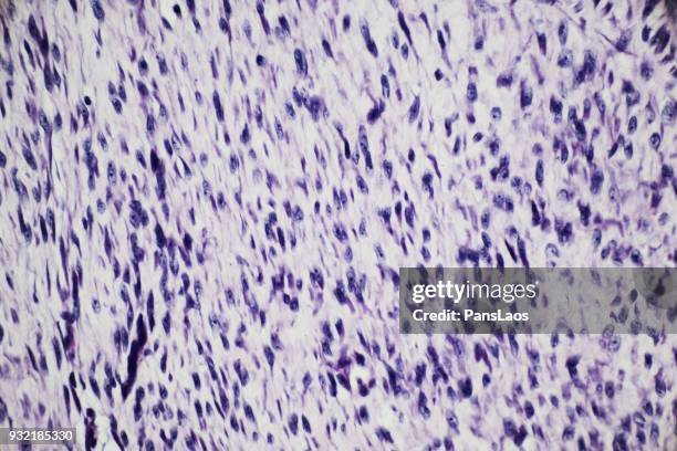 micrograph of cancer cell in human fibroma tumour - human uterus stockfoto's en -beelden