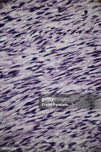 fibroma tumour of human micrograph - fibroma stock pictures, royalty-free photos & images