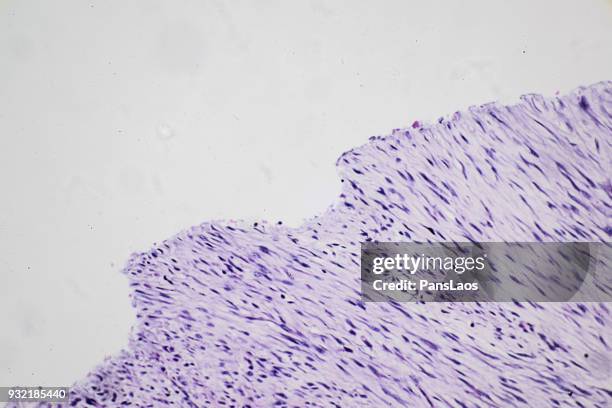 fibroma tumour of human micrograph - female reproductive organ stock pictures, royalty-free photos & images