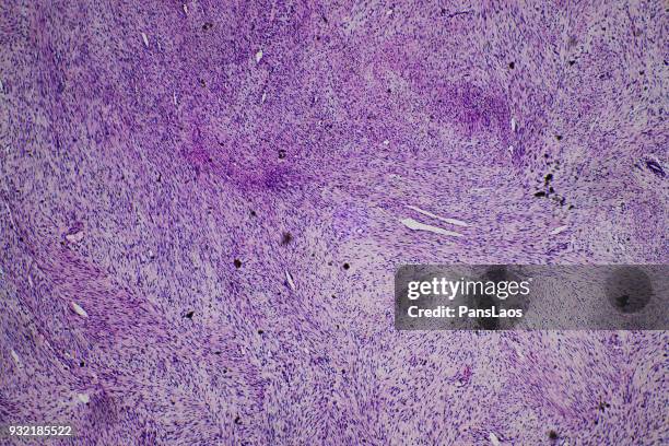 fibroma tumour of human micrograph - histerectomia fotografías e imágenes de stock