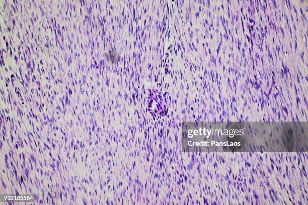 medical fibroma tumour of human - lederhuid stockfoto's en -beelden
