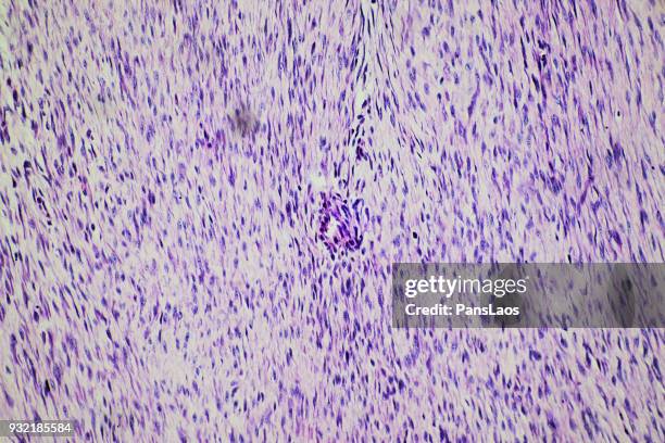 medical fibroma tumour of human - human uterus stockfoto's en -beelden