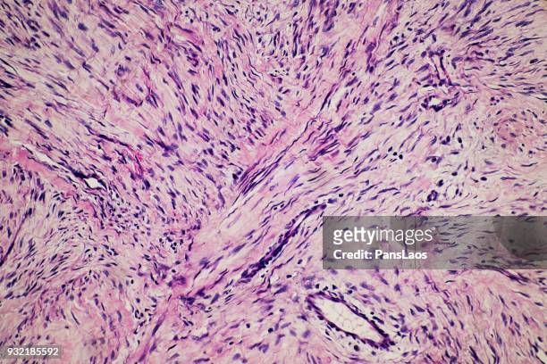 fibroma tumour of human micrograph - histerectomia fotografías e imágenes de stock