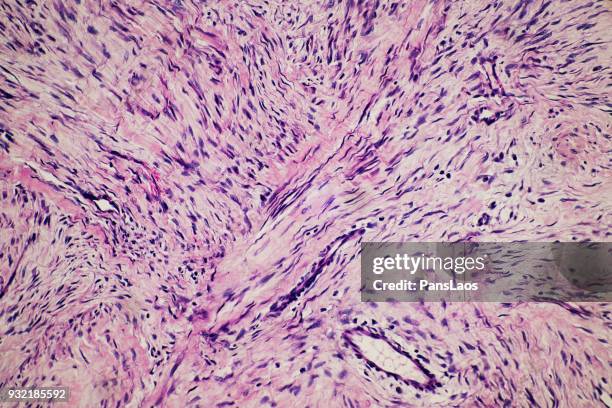 fibroma tumour of human micrograph - microphotographie immunofluorescente photos et images de collection