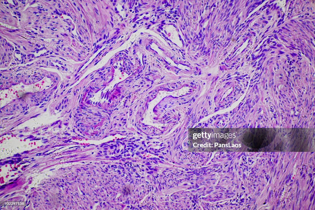 Leiomyoma uterus tumour cells of human