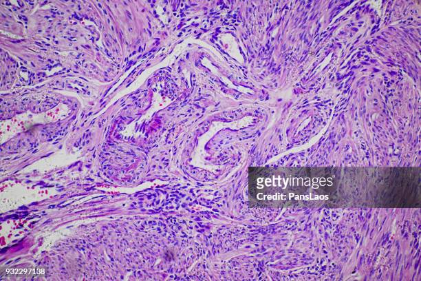 leiomyoma uterus tumour cells of human - biopsy fotografías e imágenes de stock