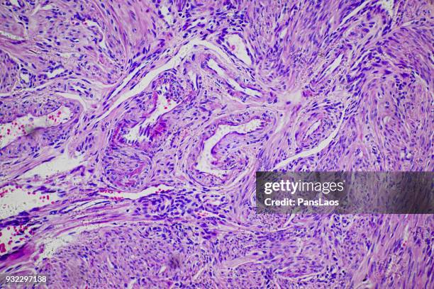 leiomyoma uterus tumour cells of human - histology 個照片及圖片檔