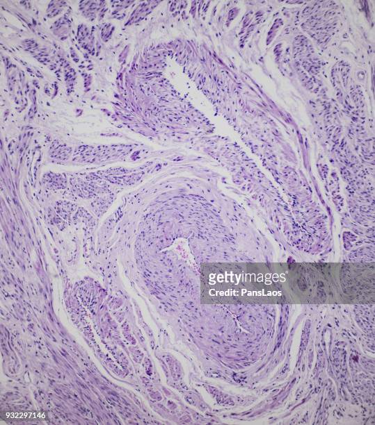 leiomyoma uterus tumour of human - glad spierweefsel stockfoto's en -beelden