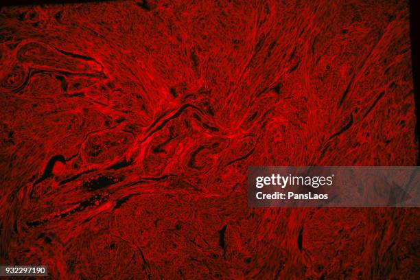 red fluorescence of human leiomyoma uterus tumour tissue - 平滑筋 ストックフォトと画像