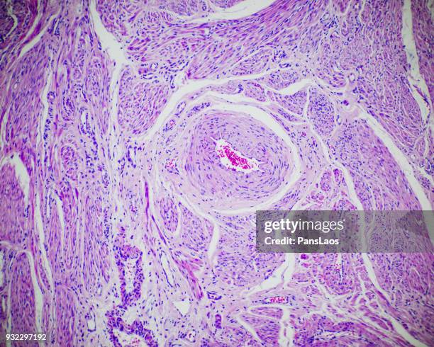 leiomyoma uterus tumour of human - light micrograph stock-fotos und bilder