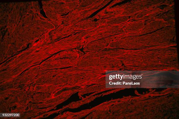 red fluorescence of human leiomyoma uterus tumour tissue - glad spierweefsel stockfoto's en -beelden