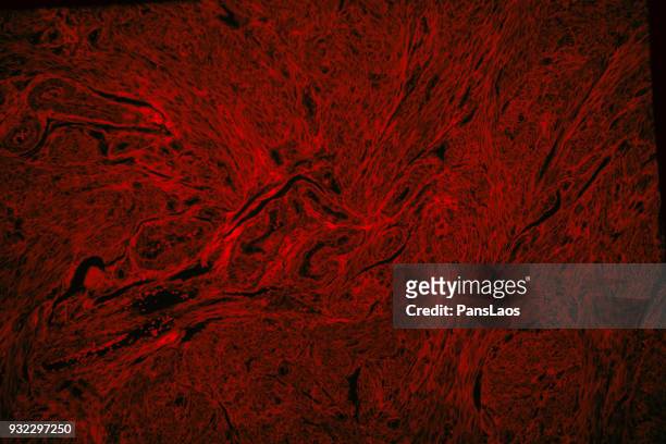 red fluorescence of human leiomyoma uterus tumour tissue - glad spierweefsel stockfoto's en -beelden