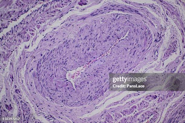 leiomyoma uterus tumour of human - glad spierweefsel stockfoto's en -beelden