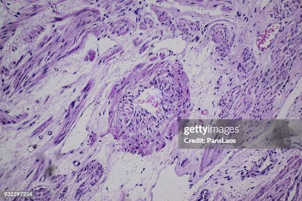 leiomyoma uterus tumour cells of human - glad spierweefsel stockfoto's en -beelden