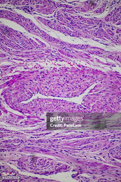 leiomyoma uterus tumour of human - 平滑筋 ストックフォトと画像