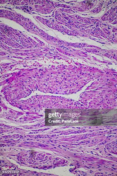leiomyoma uterus tumour of human - glad spierweefsel stockfoto's en -beelden