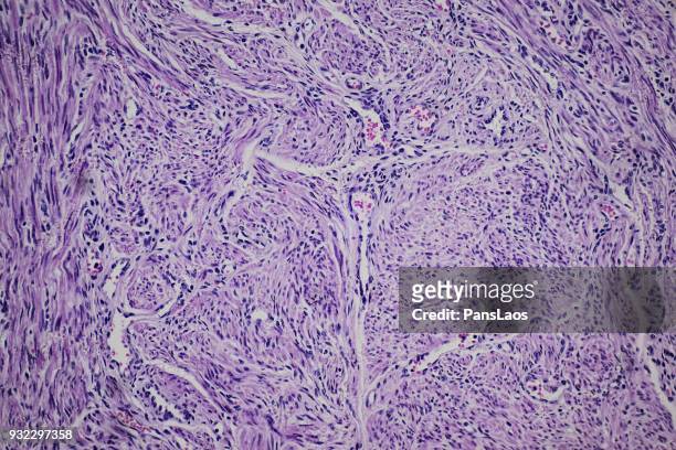 cancer cells of human leiomyoma uterus tumour - glad spierweefsel stockfoto's en -beelden