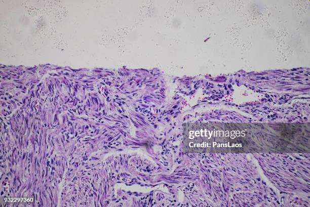 leiomyoma uterus tumour cells of human - glad spierweefsel stockfoto's en -beelden