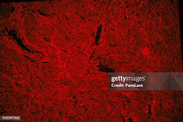 red fluorescence of human leiomyoma uterus tumour tissue - glad spierweefsel stockfoto's en -beelden