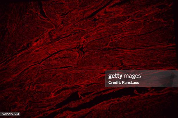 red fluorescence of human leiomyoma uterus tumour tissue - uterine wall stock pictures, royalty-free photos & images