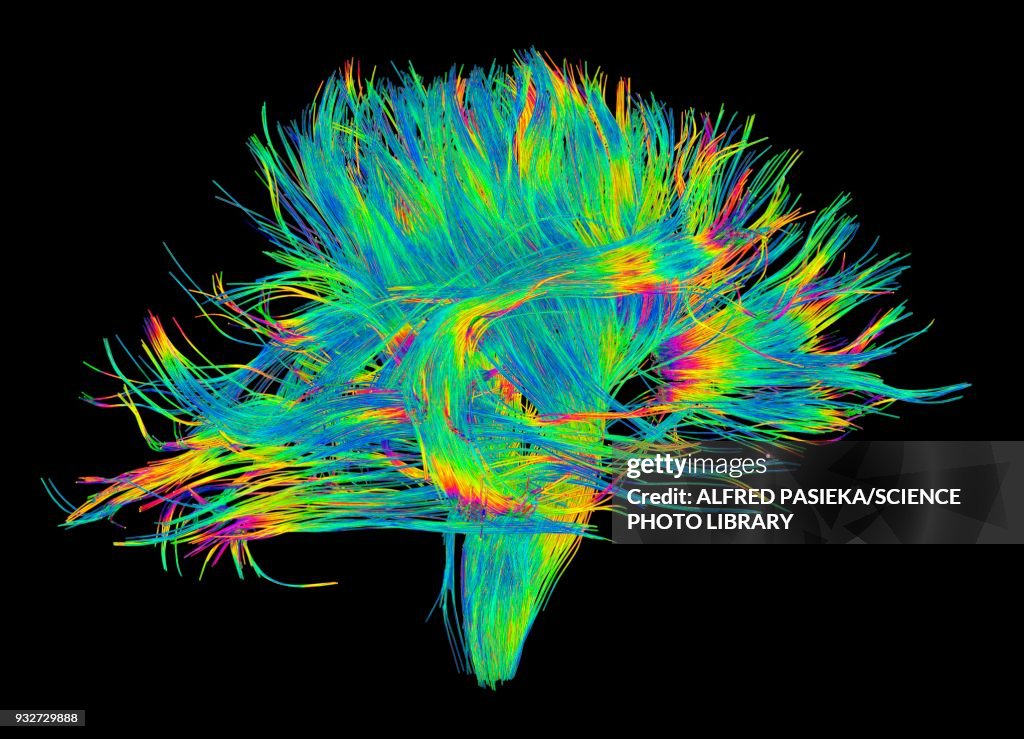 White matter fibres of the human brain, DSI scan