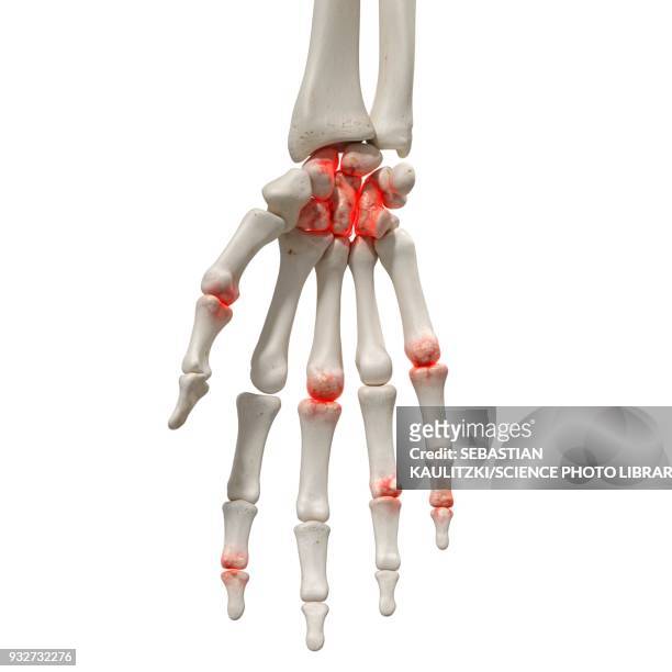 arthritis in the hand, illustration - arthritis hand 3d stock illustrations
