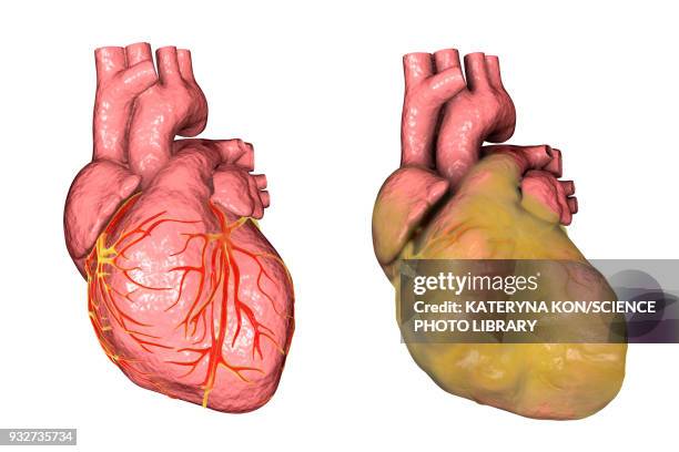 ilustraciones, imágenes clip art, dibujos animados e iconos de stock de healthy heart and heart with left ventricular hypertrophy - vena cava vena humana