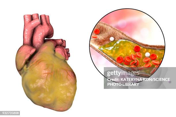 heart disease, illustration - atherosklerose stock-grafiken, -clipart, -cartoons und -symbole