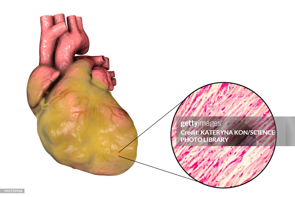 Heart with left ventricular hypertrophy, composite image