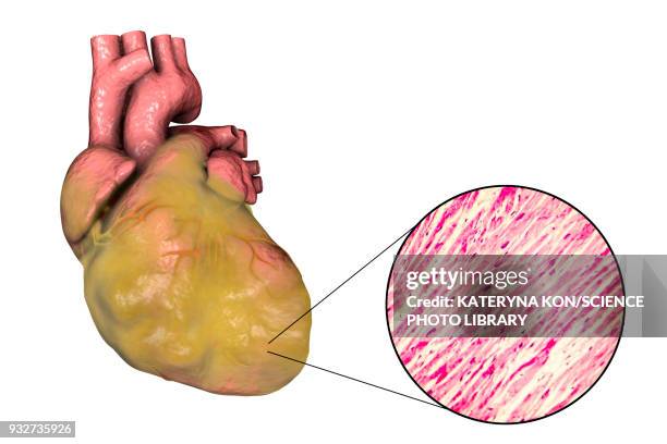 heart with left ventricular hypertrophy, composite image - 光学顕微鏡図点のイラスト素材／クリップアート素材／マンガ素材／アイコン素材