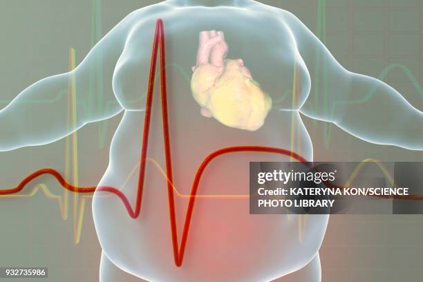 stockillustraties, clipart, cartoons en iconen met heart attack in obese man, illustration - angina