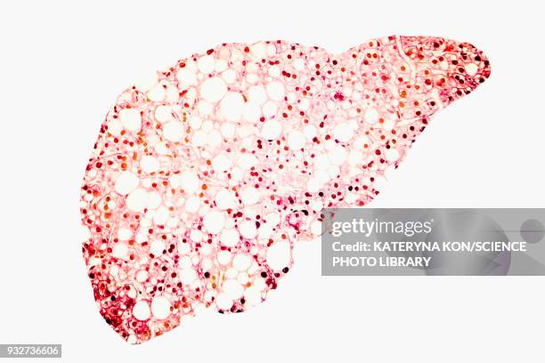 fatty liver, conceptual illustration - magnification stock illustrations