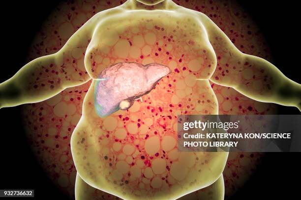 ilustraciones, imágenes clip art, dibujos animados e iconos de stock de fatty liver in obese person, conceptual illustration - célula hepática