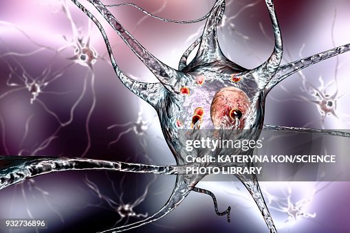 Parkinsons disease nerve cells, illustration Parkinsons disease nerve cells, illustration