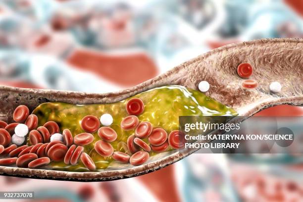 stockillustraties, clipart, cartoons en iconen met atheromatous plaque in artery, illustration - cholesterol
