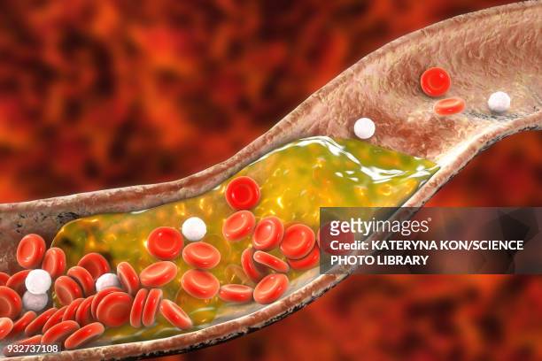 atheromatous plaque in artery, illustration - low density lipoprotein stock illustrations