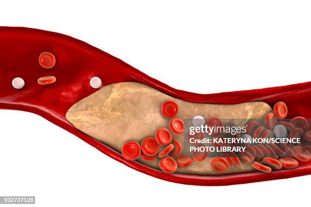 illustrazioni stock, clip art, cartoni animati e icone di tendenza di atheromatous plaque in artery, illustration - lipoproteina a bassa densità