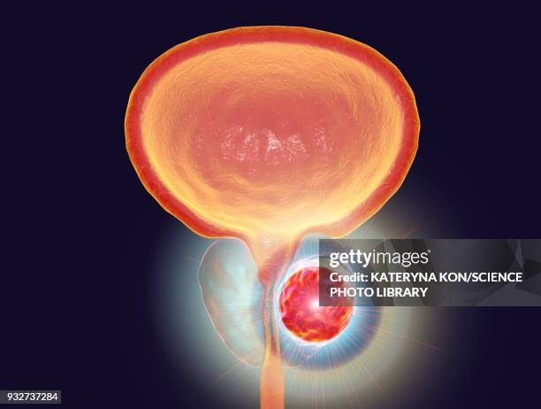 treatment of prostate cancer, conceptual illustration - exokrine drüse stock-grafiken, -clipart, -cartoons und -symbole