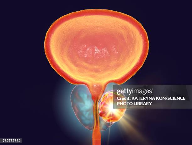 ilustraciones, imágenes clip art, dibujos animados e iconos de stock de treatment of prostate cancer, conceptual illustration - prostate gland