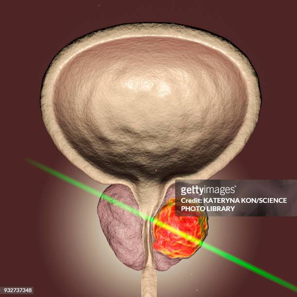 laserotherapy of prostate cancer, conceptual illustration - exokrine drüse stock-grafiken, -clipart, -cartoons und -symbole