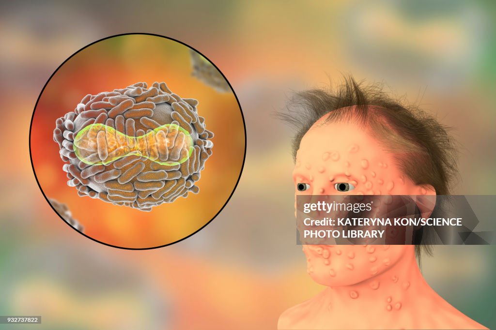 Smallpox Reference Image Smallpox Virus And Disease Illustration High-Res Vector Graphic - Getty ...