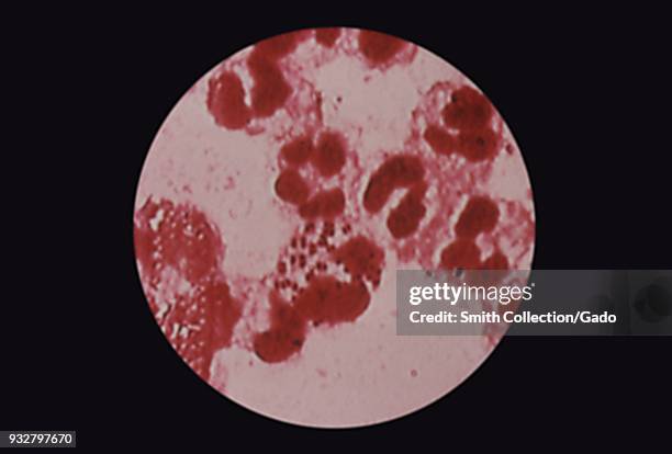 Neisseria gonorrhoeae, Gram-negative diplococcus bacterium, revealed in the photomicrograph of a urethral discharge specimen, 1978. Image courtesy...